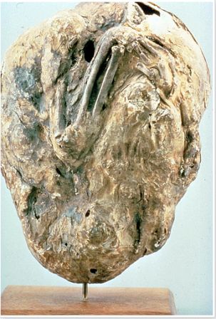 Lithopedion.png, nov. 2012